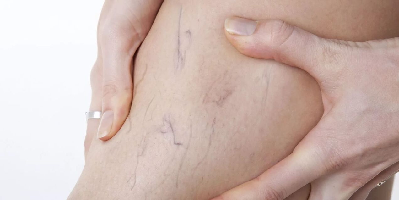 Antes del uso de la crema de varicones