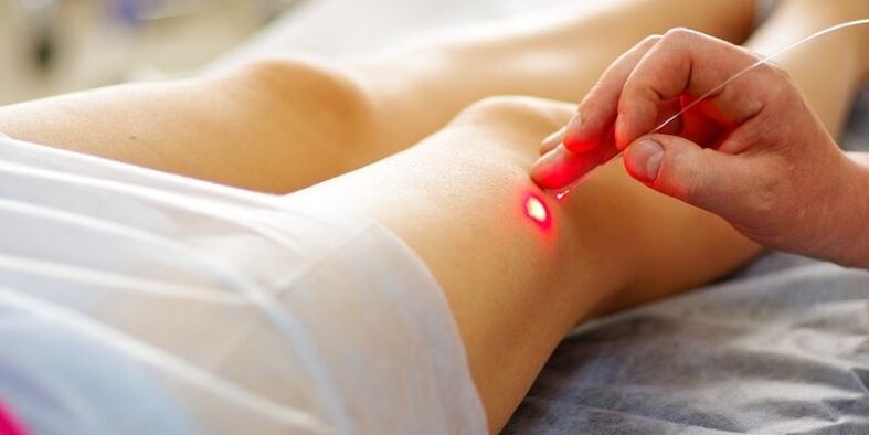 El procedimiento de coagulación endovenosa con láser de venas para venas varicosas.