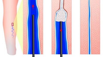escleroterapia para venas varicosas