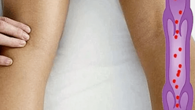 Las razones para el desarrollo de las venas varicosas de las extremidades inferiores