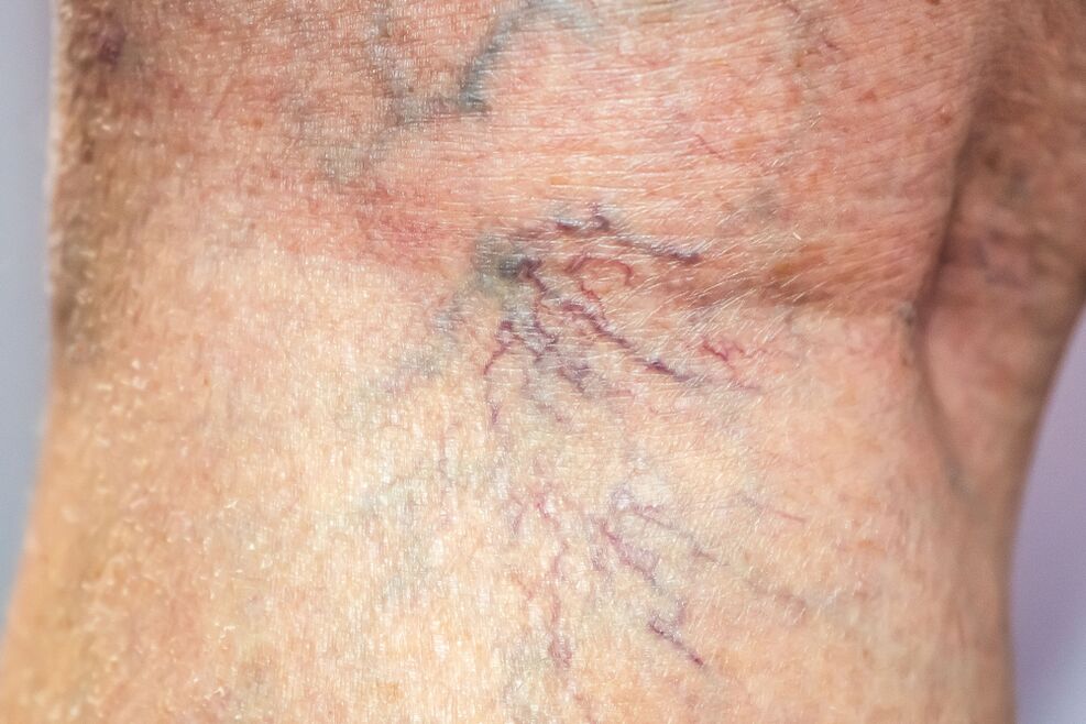 varices